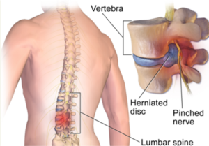 disc herniation picture