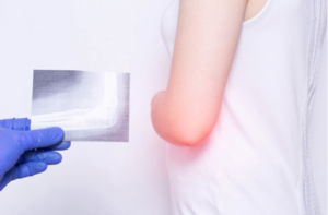 a medical bursitis examination of the elbow